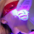 Tẩy trắng răng bằng Laser có tốt không?