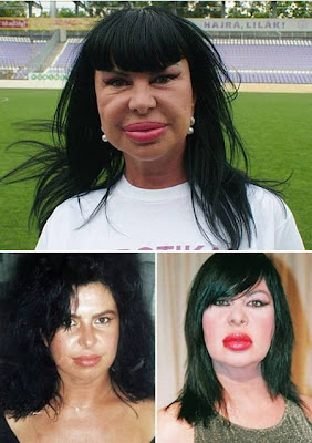 Weirdiest Plastic Surgery Makeovers Seen On www.coolpicturegallery.us