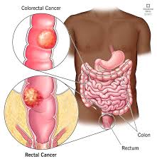 Why should we check our stool?  Signs helpful in colon cancer diagnosis