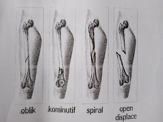 Gambar Pemeriksaan Penunjang Fraktur Femur Dan Komplikasinya