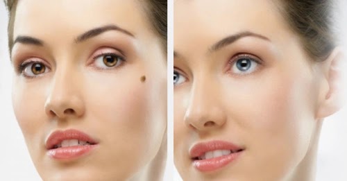 Easy Way to Remove Moles Naturally at Home in One Day