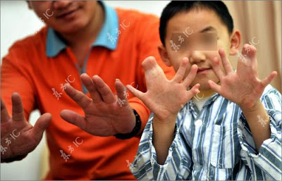 boy with 15 fingers and 16 toes