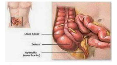 Makalah Askep Apendisitis Pre Operasi dan Post Operasi pdf, doc, askep apendisitis, askep apendisitis pre operasi, askep apendisitis post operasi