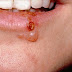 Cold Sore In Mouth That Won't Go Away : Purchasing Std Medication For Herpes Coming From An On The Web Pharmacy