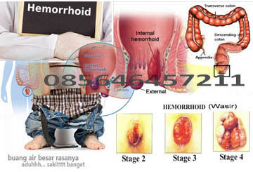 Harga Obat Wasir Bengkak Di Apotik Umum