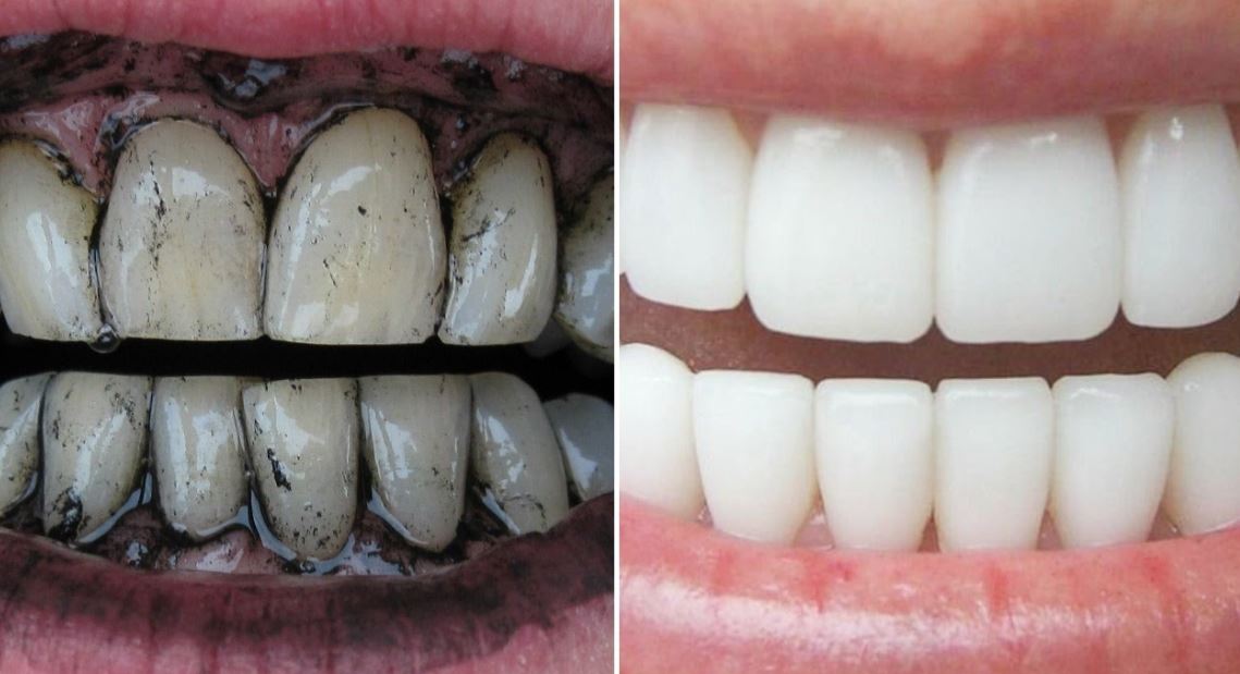 Cara Memutihkan Gigi Kuning Dengan 15 Bahan Alami Aman Dan Cepat Tips Cantik Terkini