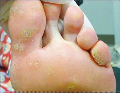 common warts on fingers. Plantar warts are noncancerous