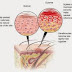 LAPORAN PENDAHULUAN DERMATITIS