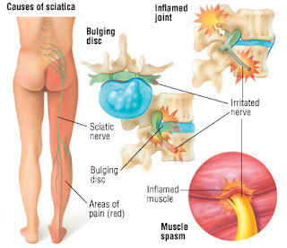 Injury- Upper/Lower Back Pain