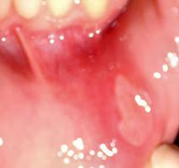 canker sores