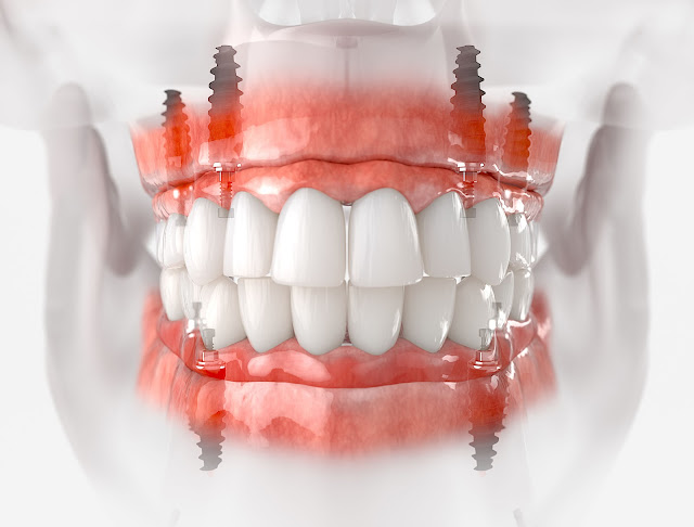 is dental implants painful