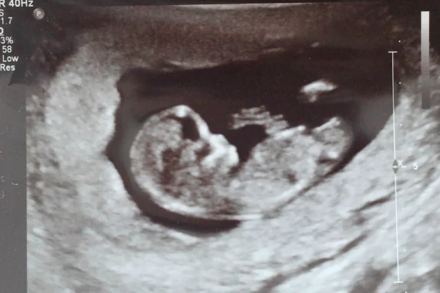 11w5d