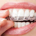 Niềng răng đang bị ê buốt đảm bảo với công nghệ 3D Speed