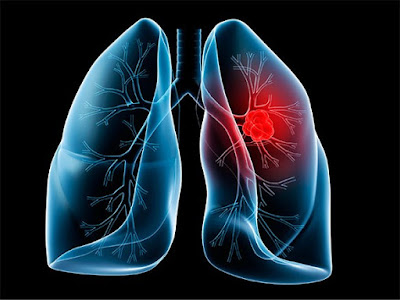 Mesothelioma Legal Ramifications