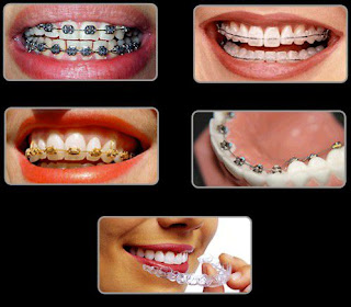 Các phương pháp niềng răng hiện đang được áp dụng phổ biến