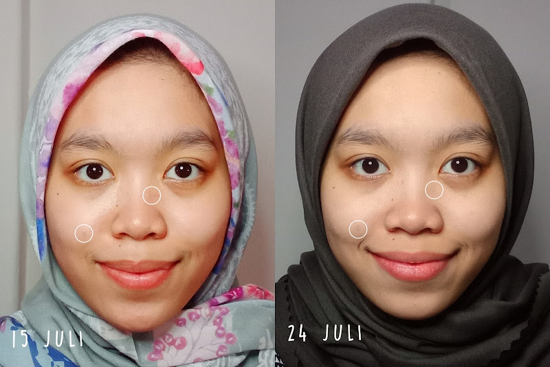 before after elsheskin retinol