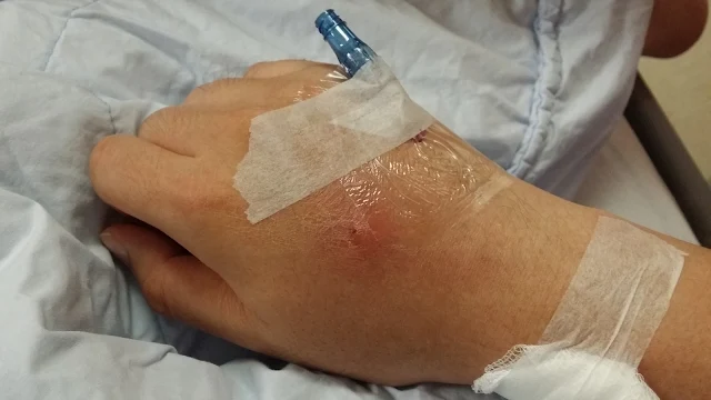 The "heparin block" on the right hand