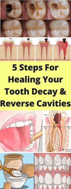 Here 5 Steps For Healing Your Tooth decay & Reverse Cavities!!!