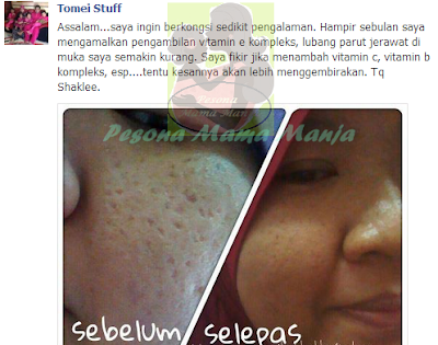 Parut Jerawat Hilang Dengan Vitamin E Shaklee