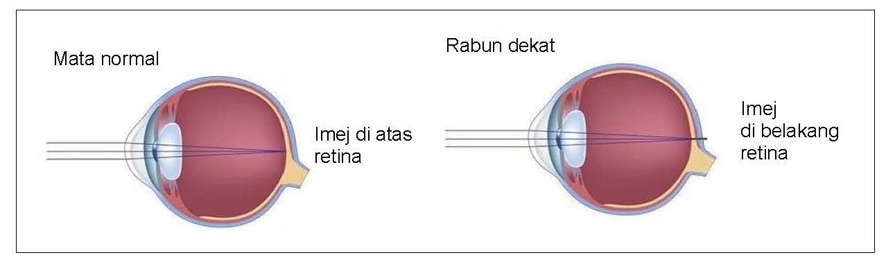 Apa Itu Rabun Dekat (Hiperopia) - Petua Kurangkan Rabun