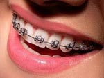 Dont Forget this Braces Treatment