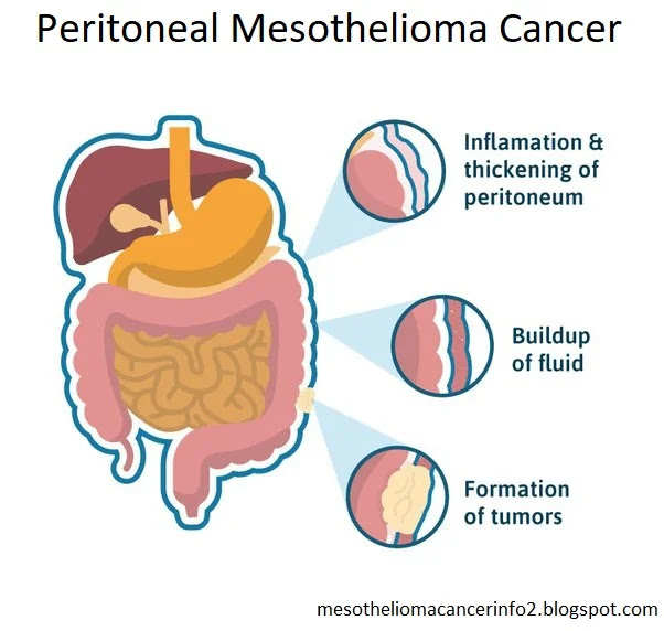How to Spot the Early Warning Signs of Peritoneal Mesothelioma Cancer