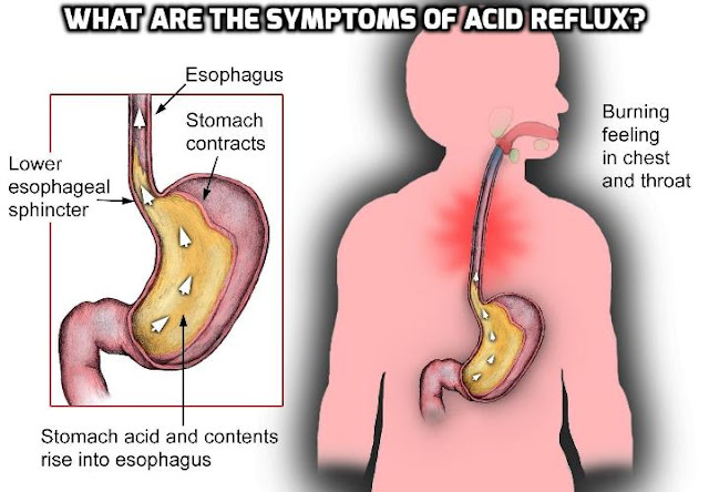 Since acid reflux, also called GERD (gastroesophageal reflux disease), can cause patients a great deal of discomfort and result in severe complications, it is highly important to know how to identify symptoms of acid reflux in order to quickly diagnose and treat it. 