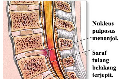 pengobatan saraf terjepit