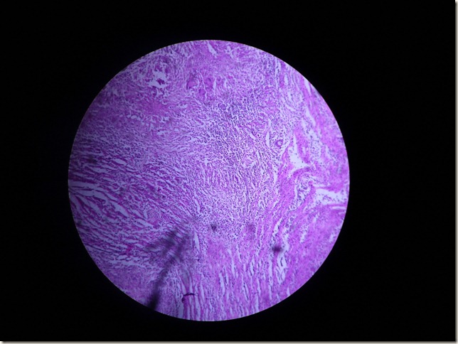 TB granuloma