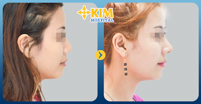 Hình ảnh trước và sau khi nâng mũi tại KIM Hospital