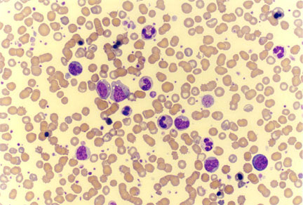 Myelofibrosis