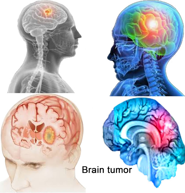 Brain Tumor.