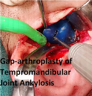 Case studies in Oral Health Science, Case studies in ENT, Case Report in ENT, Gap-arthroplasty of Tempromandibular Joint Ankylosis, Feasibilty of Preplanned Computer Guided Gap-arthroplasty, Case Report in Maxillofacial Surgery 