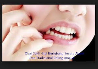 Obat-Sakit-Gigi-Berlubang-Secara-Alami-Dan-Tradisional-Paling-Ampuh