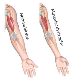 Muscular dystrophy in India