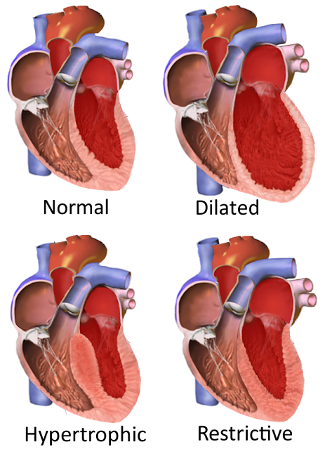 Jenis kardiomiopati dan manifestasinya macam type jantung heart cardiomiopathy types manifestation