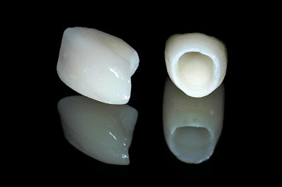 Thông tin về bọc răng sứ 