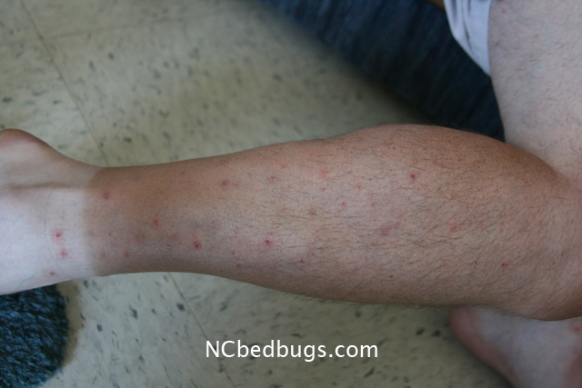 Bite marks on skin may be a sign of bed bug infestation; however, â€¦