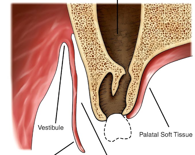 PDF: Management of Oro-antral Communication and Fistula: Various Surgical Options