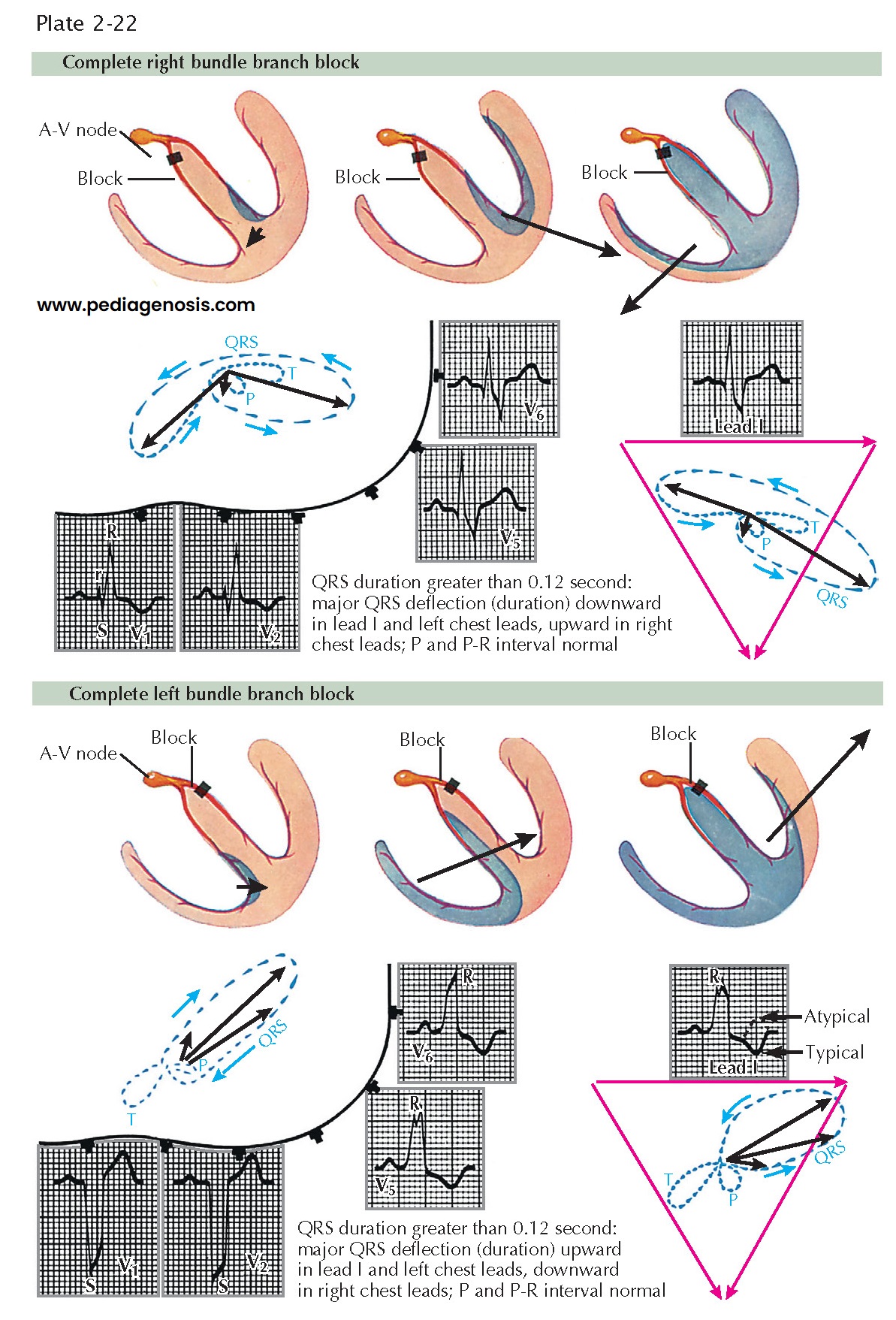 BUNDLE BRANCH BLOCK