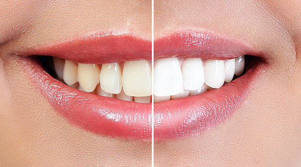 4 Cara Memutihkan Gigi Kuning yang Membandel dengan Alami 