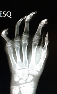 dedo quebrado da mão