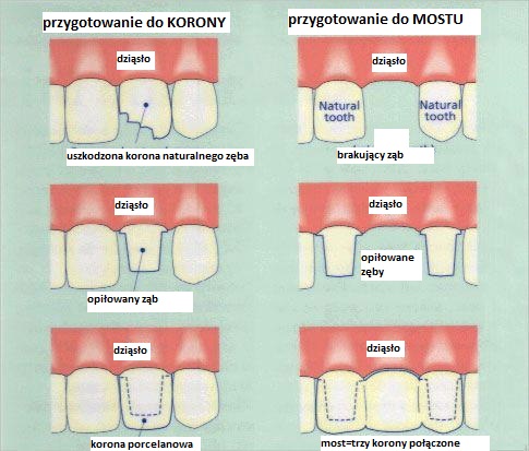 Sztuczny ząb koszt