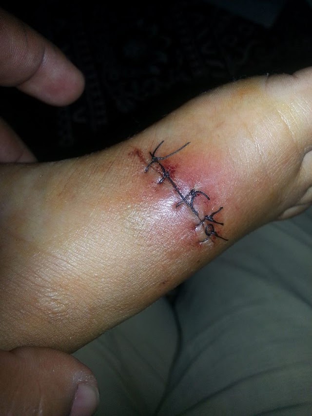 The story of how I got a scar on my right foot.