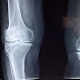 Joint Replacement pain - Pain after joint replacement