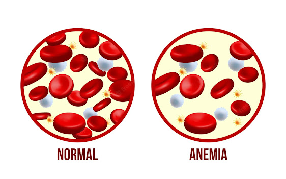 Normal and anemic blood cells