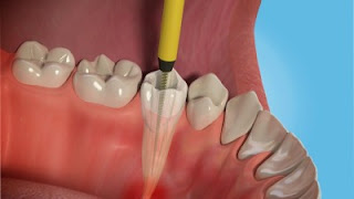 Root Canal Treatment In Gurgaon