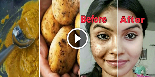 How To Remove Dark Spots Of Face In 7 Days!