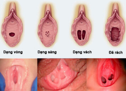 Các dạng màng trinh và hình ảnh màng trinh đã rách