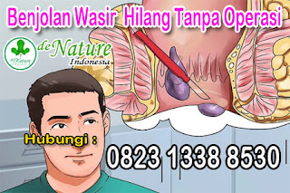 Nama Merk Obat Di Apotik Penghilang Benjolan Ambeien Terbukti Paling Ampuh